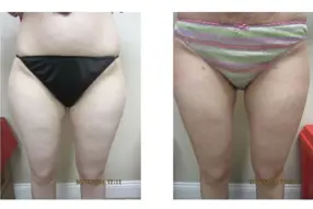 Before and after of thigh  liposuction by Dr. Drew Varano in Washington DC